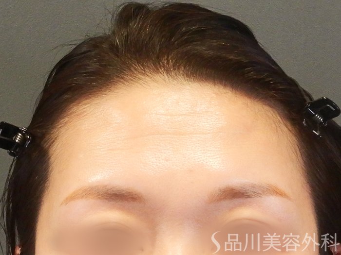 症例NO.63542のBEFORE写真