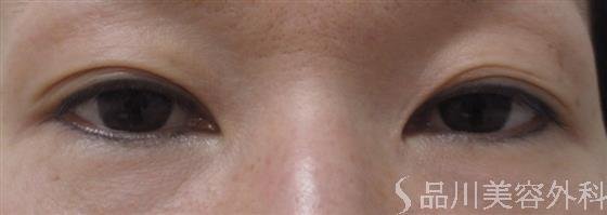 症例NO.20763のBEFORE写真