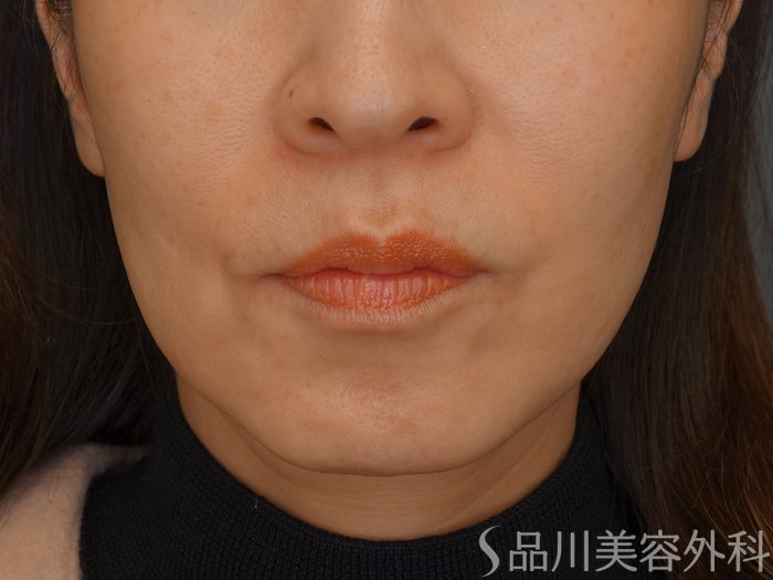 症例NO.69436のBEFORE写真