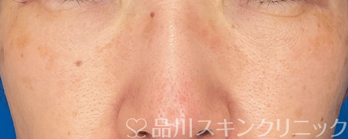 症例NO.73917のAFTER写真