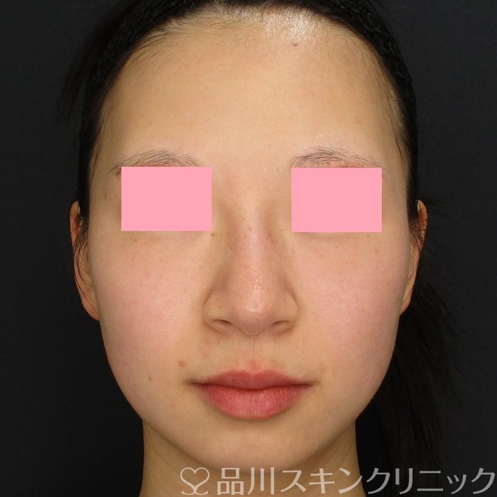 症例NO.73930のBEFORE写真