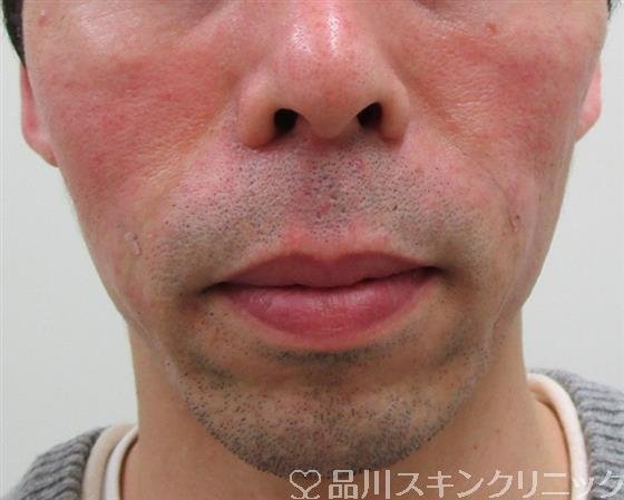 症例NO.33446のAFTER写真
