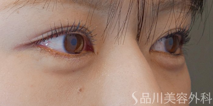 症例NO.72070のAFTER写真