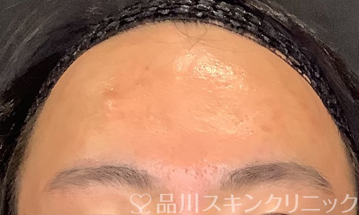 症例NO.70389のAFTER写真