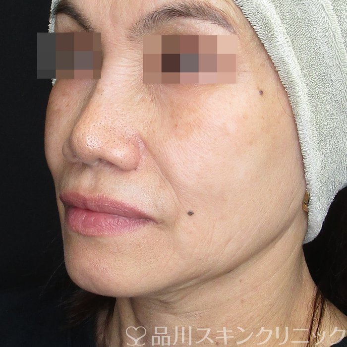 症例NO.73805のAFTER写真
