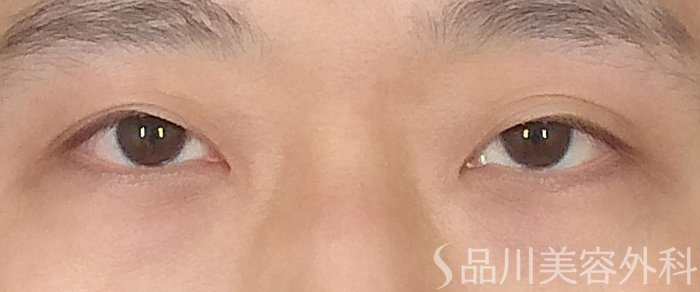 症例NO.71840のBEFORE写真