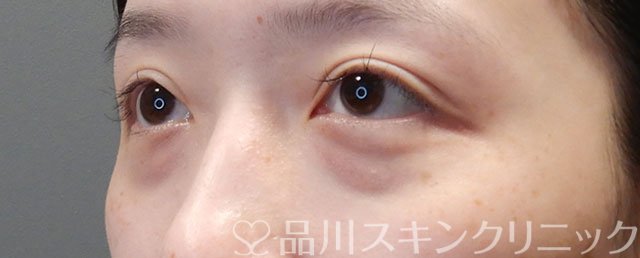 症例NO.71913のBEFORE写真