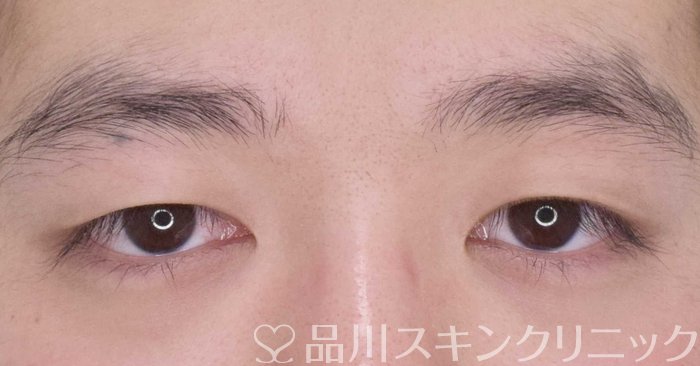 症例NO.64807のBEFORE写真