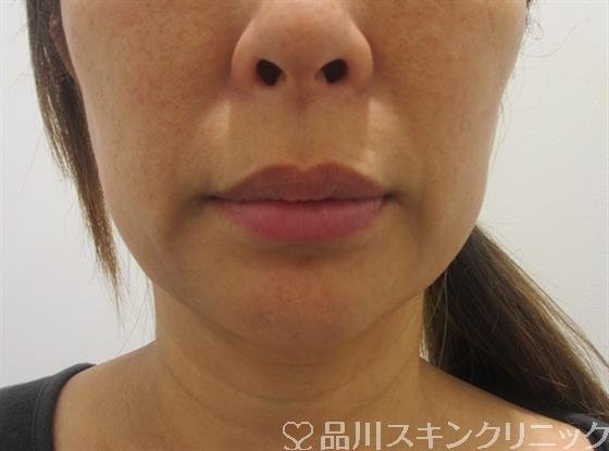 症例NO.33314のBEFORE写真