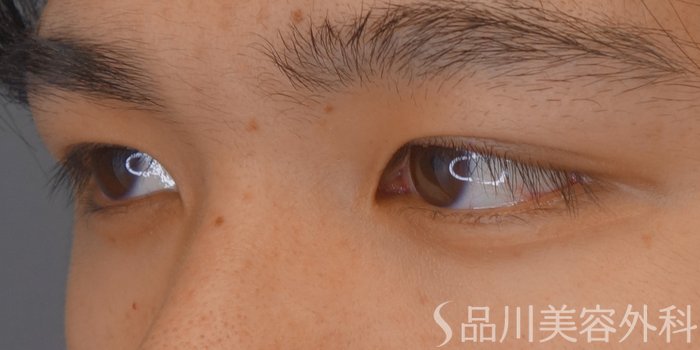 症例NO.69640のBEFORE写真