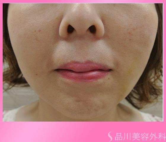 症例NO.11641のAFTER写真