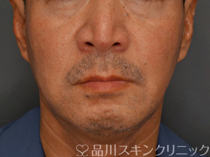 症例NO.73899のBEFORE写真