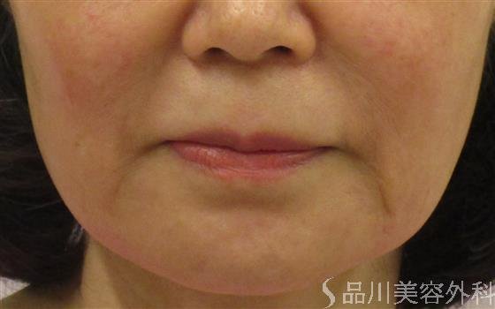 症例NO.57792のBEFORE写真