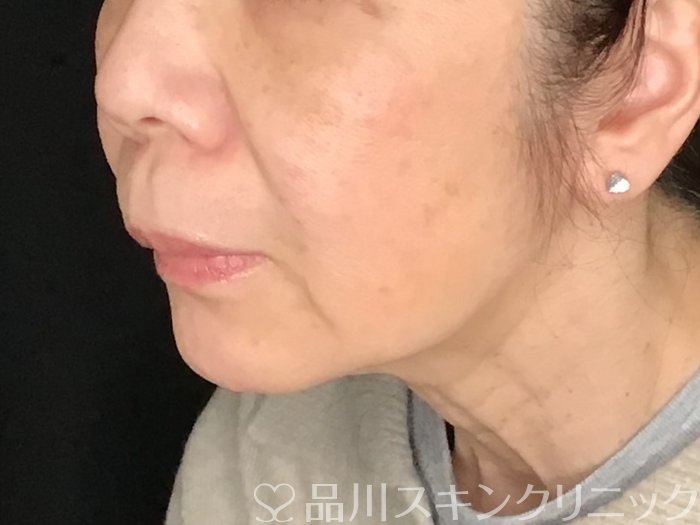 症例NO.64991のBEFORE写真