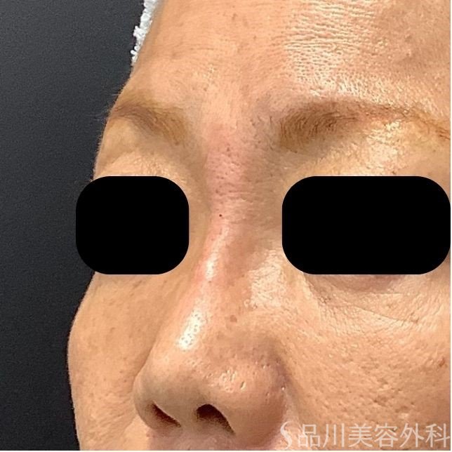 症例NO.75311のAFTER写真
