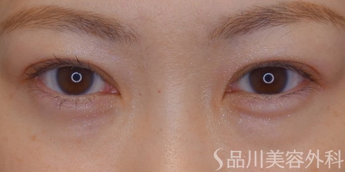 症例NO.74020のAFTER写真