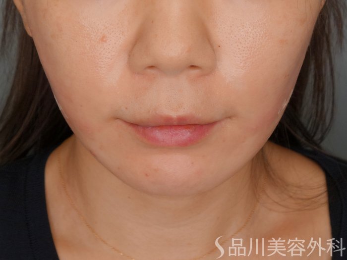 症例NO.70061のAFTER写真