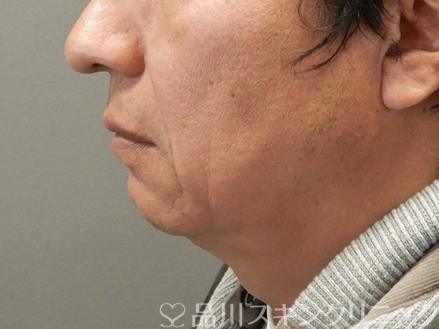 症例NO.75134のBEFORE写真
