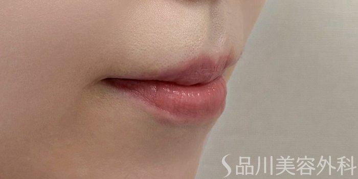 症例NO.70190のBEFORE写真