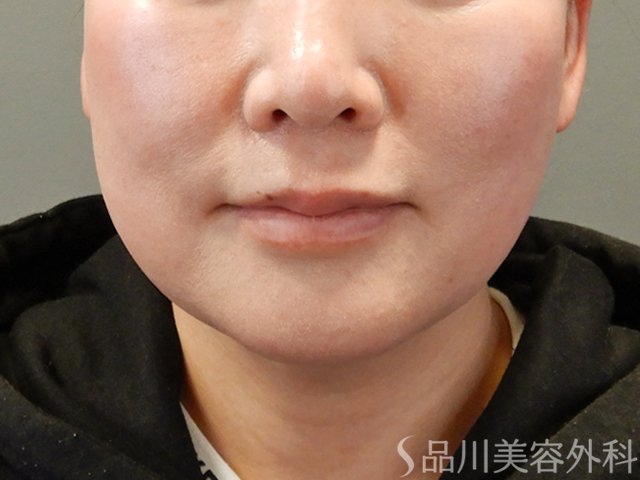症例NO.75064のBEFORE写真