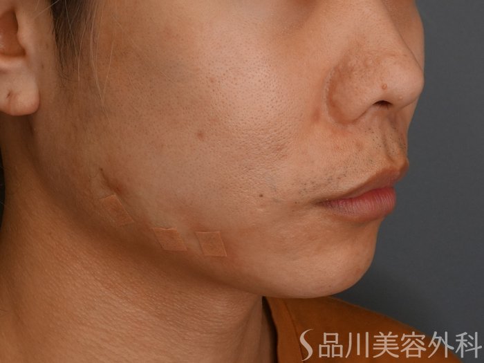 症例NO.73755のAFTER写真