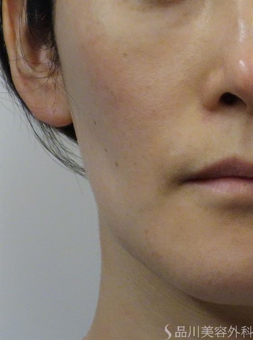 症例NO.52281のBEFORE写真