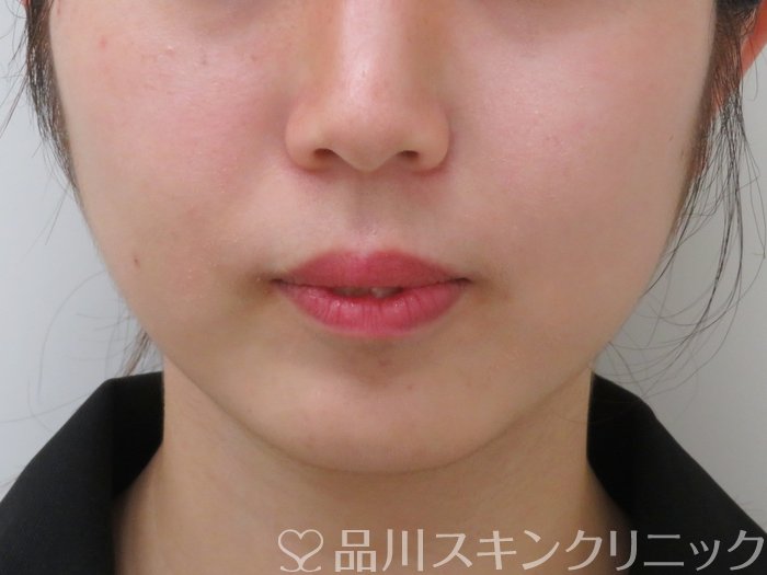 症例NO.65853のAFTER写真