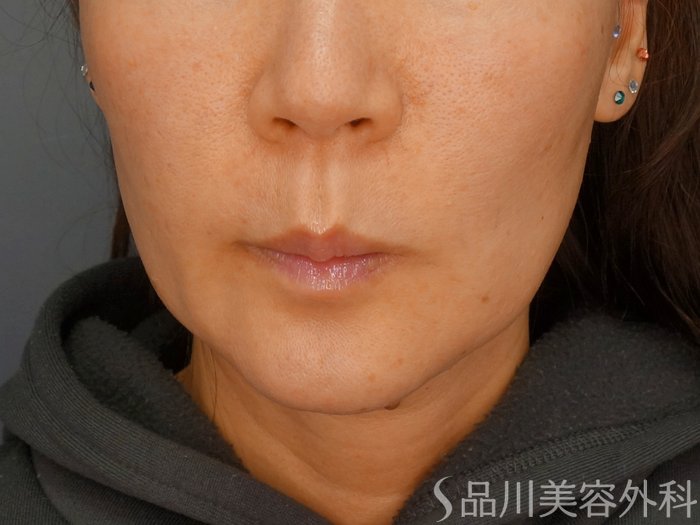 症例NO.72679のBEFORE写真