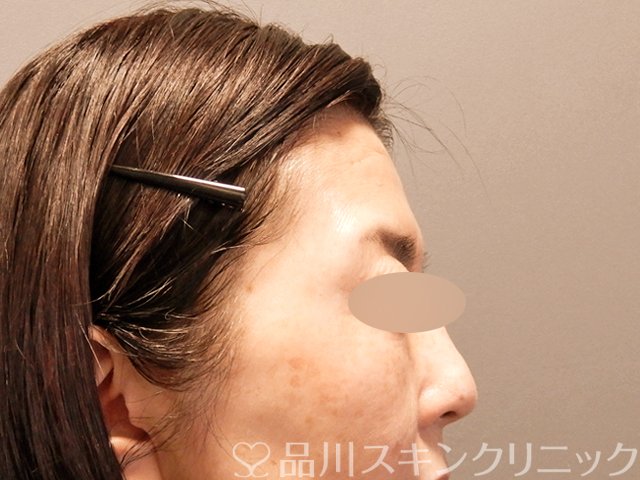 症例NO.71084のBEFORE写真