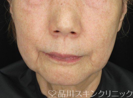 症例NO.65500のBEFORE写真