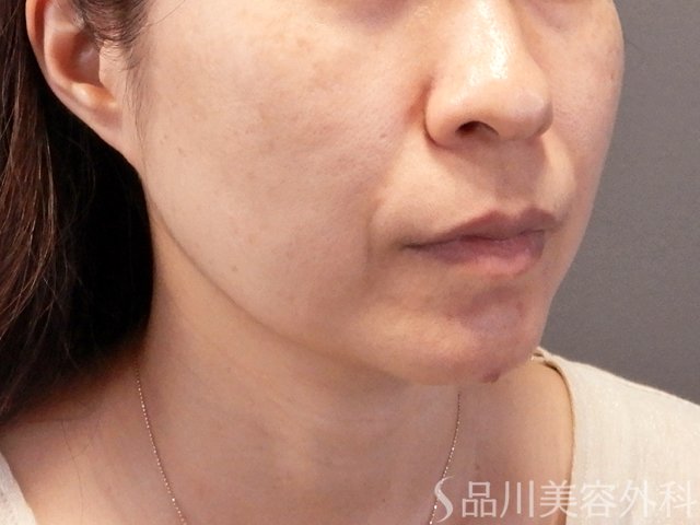 症例NO.67599のBEFORE写真