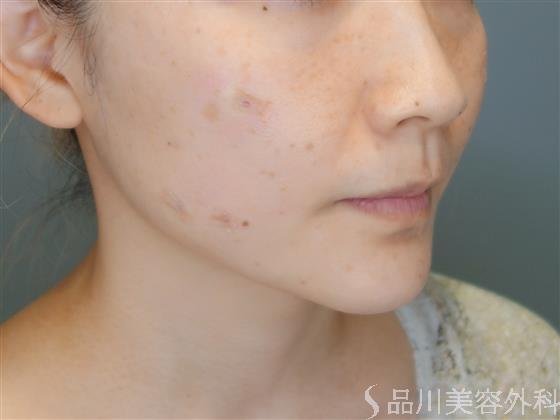 症例NO.52146のAFTER写真
