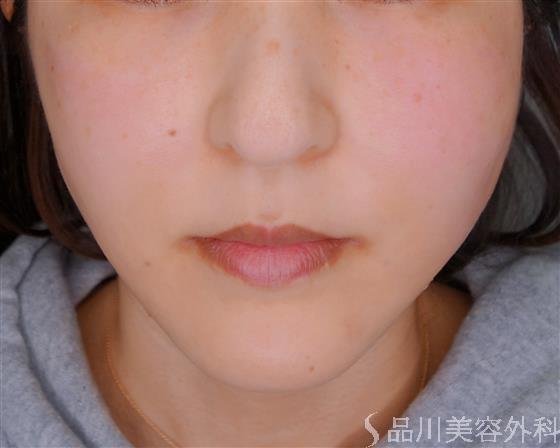症例NO.54068のAFTER写真