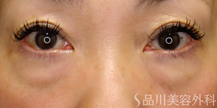 症例NO.71786のBEFORE写真