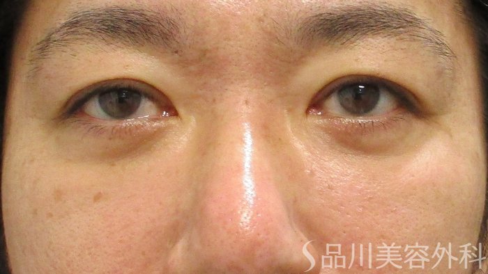 症例NO.70668のAFTER写真