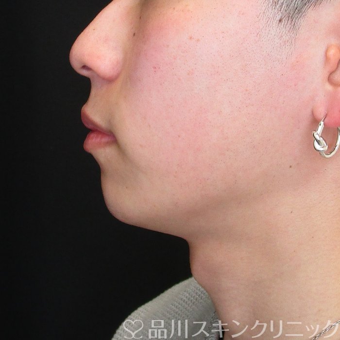 症例NO.73728のBEFORE写真