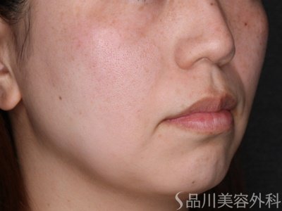 症例NO.74241のBEFORE写真