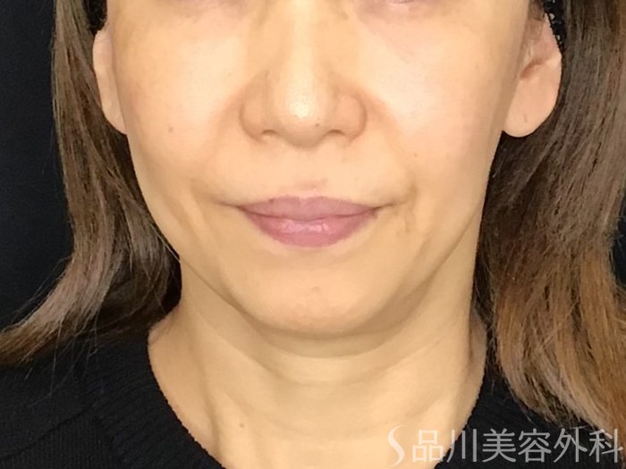 症例NO.69510のBEFORE写真