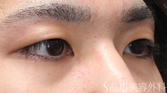 症例NO.74778のBEFORE写真