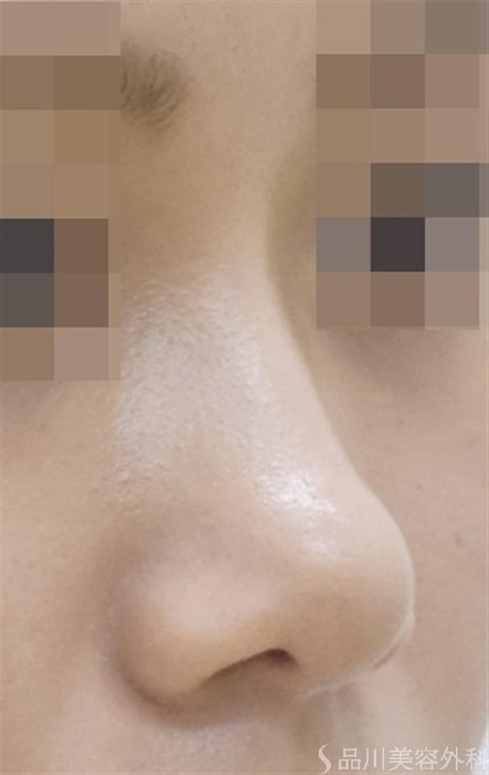 症例NO.47156のAFTER写真