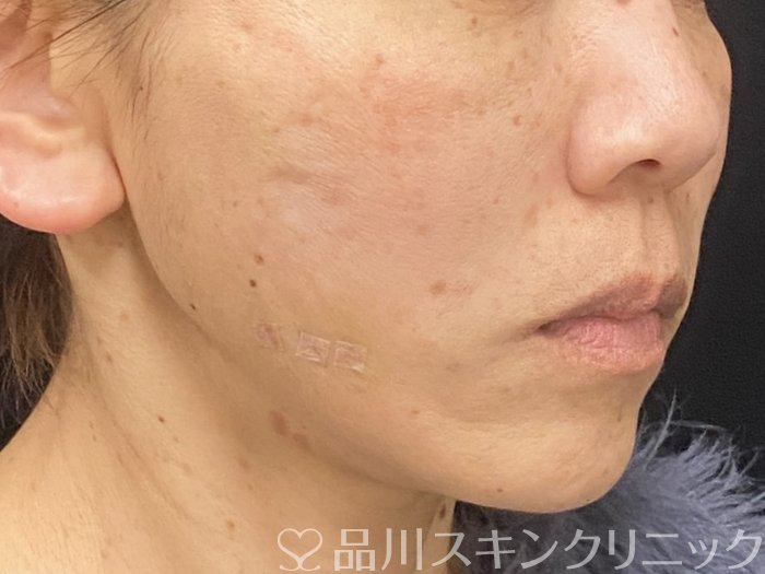 症例NO.73583のAFTER写真