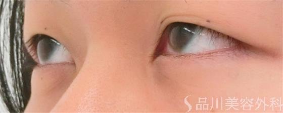 症例NO.25130のBEFORE写真