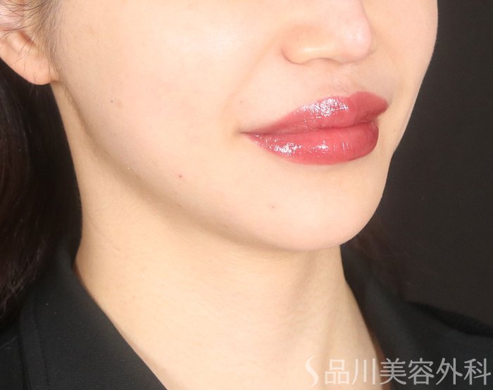 症例NO.73534のAFTER写真