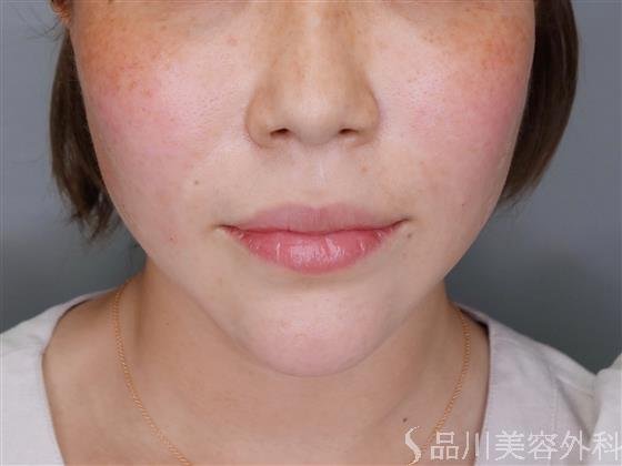 症例NO.51241のAFTER写真