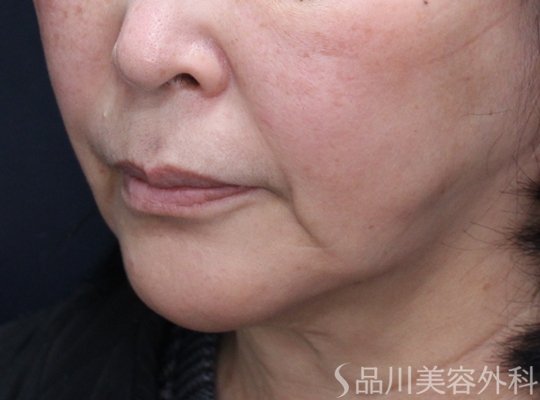 症例NO.72985のBEFORE写真