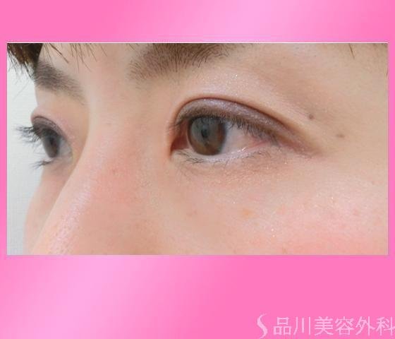 症例NO.14204のAFTER写真