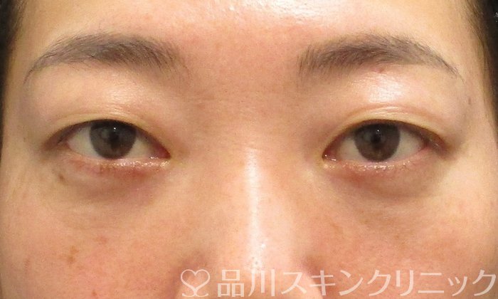 症例NO.69722のAFTER写真