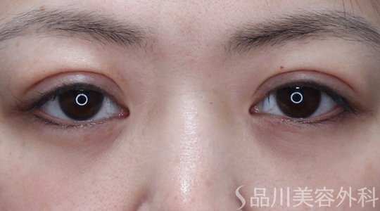 症例NO.74047のAFTER写真