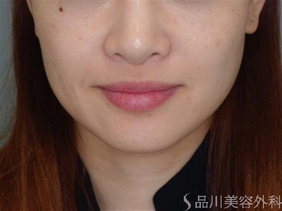 症例NO.50252のBEFORE写真