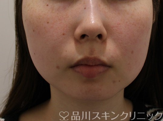 症例NO.72721のBEFORE写真